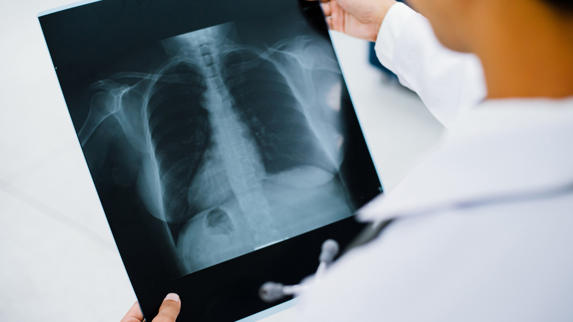 Chest X-ray film showing normal lungs versus abnormal findings including pneumonia and lung masses for health screening at HOP Medical Centre Singapore