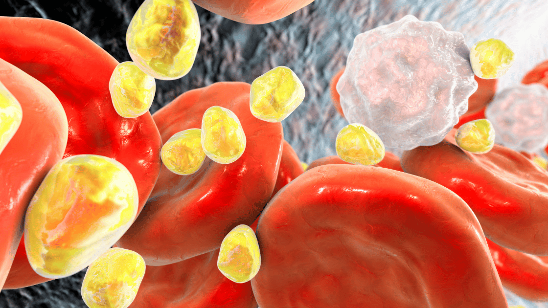 High cholesterol Singapore - medical illustration showing cholesterol plaque buildup in arterial blood vessels causing blockage