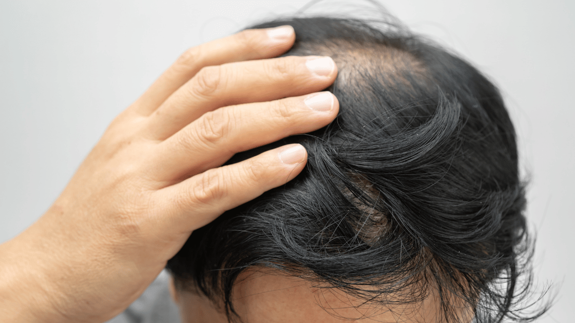 Close-up of thinning hair and scalp showing hair loss — illustrating the need for medical hair loss assessment at HOP Medical Centre Singapore